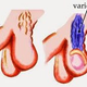 Illustration for article titled Obat Herbal Buat Varikokel